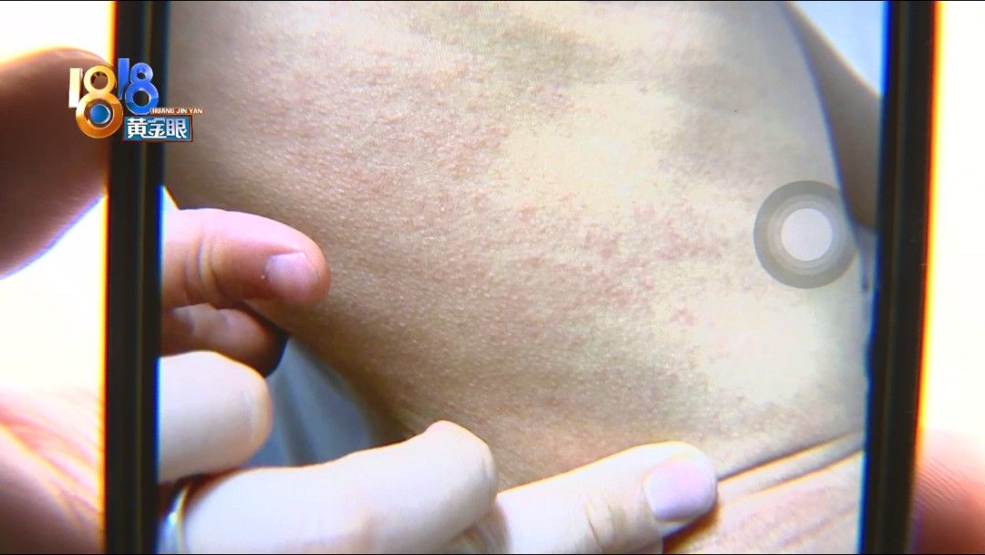 王女士|孩子身上爆发红疹，母亲怀疑泳池水质