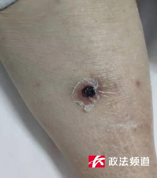 老人|七旬老人反复高热不退，竟是被这种小虫给咬了！