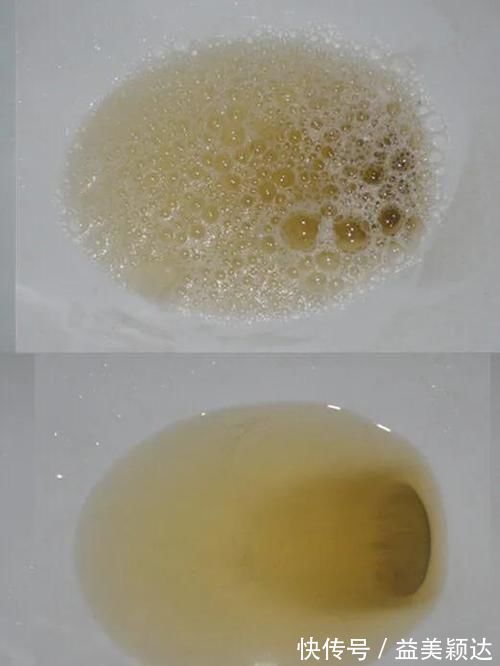 张力|尿中为什么有泡沫?泡沫尿就一定代表有肾脏病吗?医生告诉你