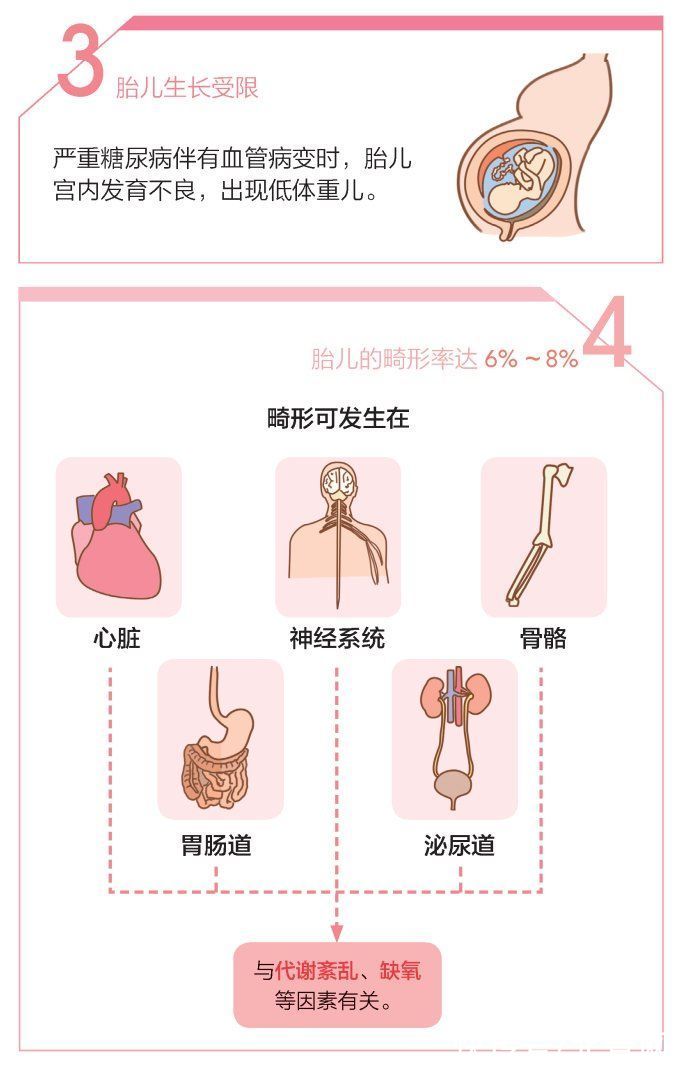 糖尿病|孕妈妈为何会患糖尿病？糖尿病对孕妈妈、宝宝及新生儿都存在哪些影响