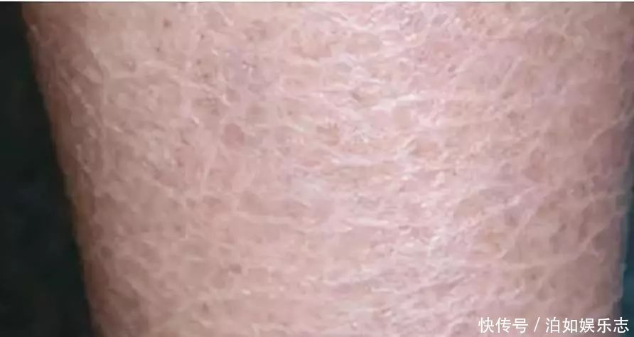 小腿长“鱼鳞”,脚后跟炸裂!这么做,还你水嫩肌肤!赶紧收藏!