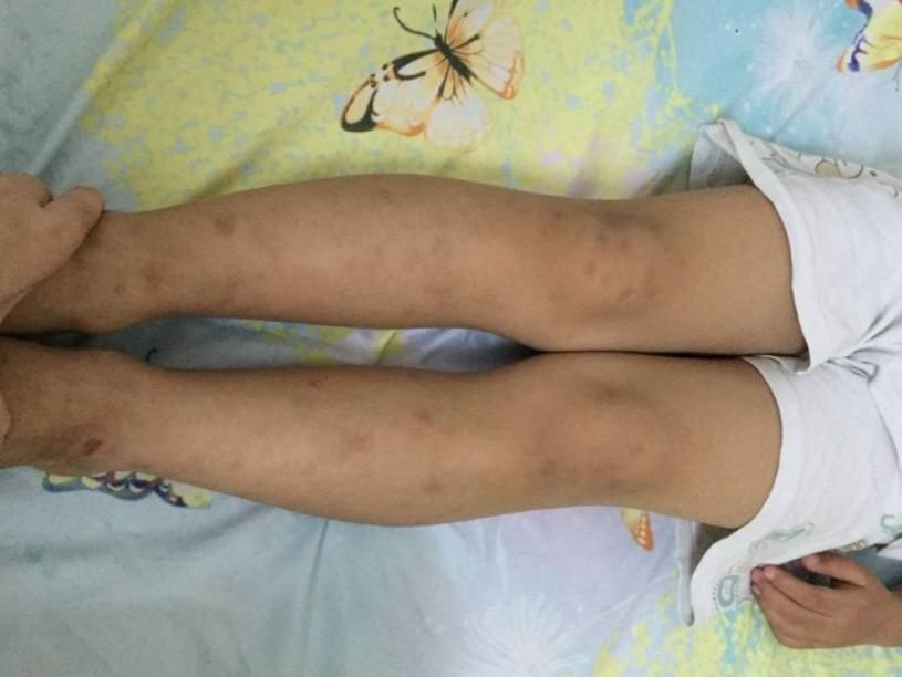 x型腿|孩子缺钙时,身体会出现4种信号,多给孩子吃3物,补钙质长个高