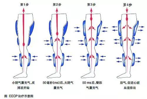 收缩期|潍坊市人民医院专家为您讲解什么是体外反搏？