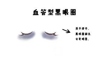 黑眼圈
