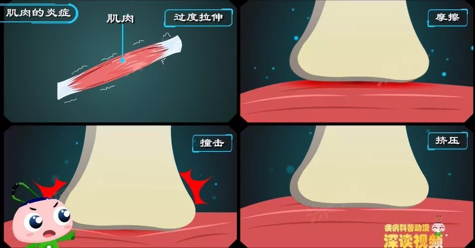 关节|肩膀疼到抬不起来？长期加班易中招？肩周炎发病因素知多少