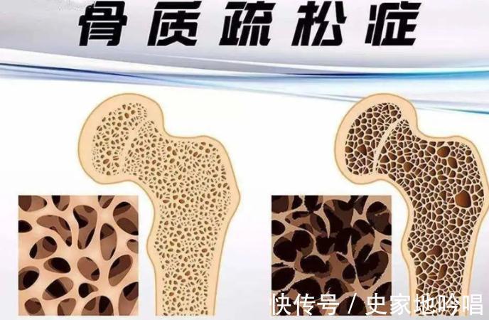 强健|红薯是骨质疏松的催化剂吗?提示:强健骨骼,建议牢记4件事
