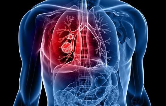 发烧|出现这种咳嗽, 别以为是感冒问题, 它可能是肺癌发出的信号!