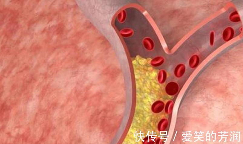 脑卒中|颈动脉斑块是否能逆转?医生道出4个注意事项,不妨收藏下!