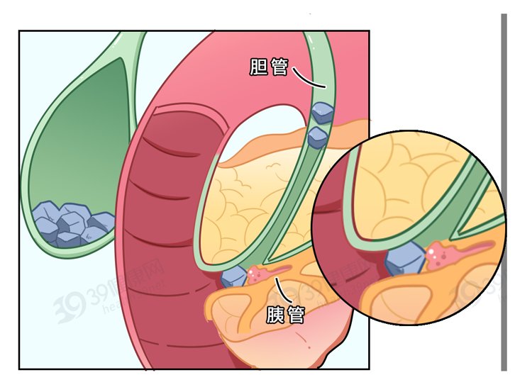 胰腺|癌症之王“胰腺癌”，不要以为是胃病！出现3个症状，及时就医