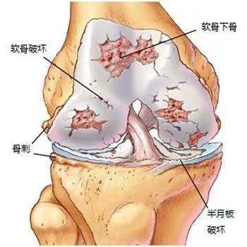 游离体|膝关节经常时咔咔的响，正常吗？