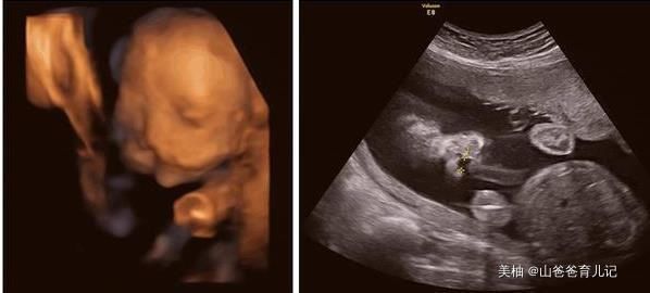 畸形儿|妻子怀孕看B超以为双胞胎,欣喜若狂,但孩子出生后,全家乱了套