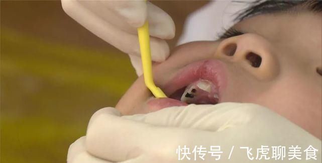 孩子|宝宝满口蛀牙?不一定是糖果惹的祸,这些常见举动更易引发龋齿