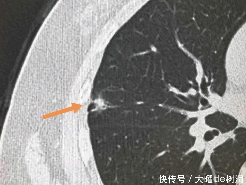  年年体检，为什么还得了晚期肺癌？体检有啥用！