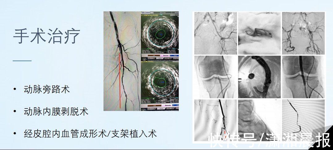 下肢动脉硬化闭塞症|冬天脚凉？警惕血管病变