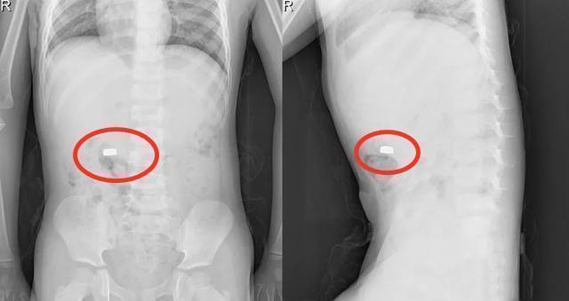 坏习惯|“妈,我和你说个秘密”,宝妈听完后一身冷汗,抱起儿子直奔医院