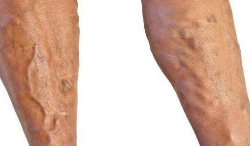 头痛|头痛失眠、流鼻血……这些毛病别忽视!或可能是缺乏营养引起的