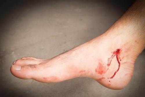 腿脚|血糖正不正常，看看腿脚就知道，腿上若有3种迹象，要提高警惕