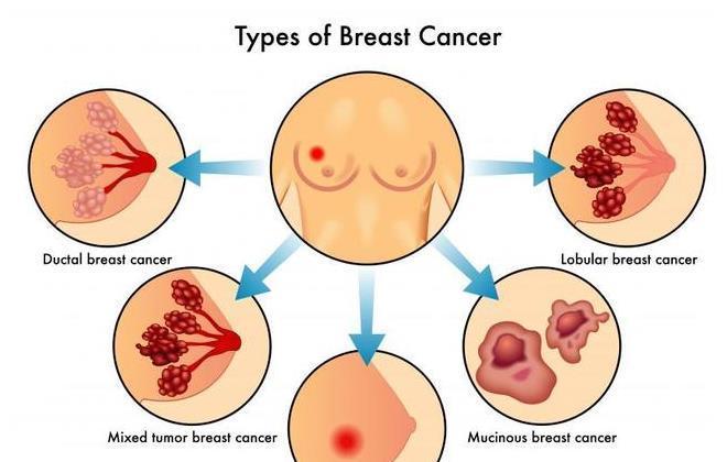 风险|如何降低乳腺癌风险？女性朋友们，这些“功课”要提前了解