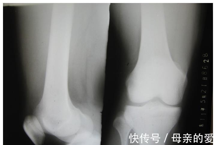 女孩子|女儿11岁来月经是早熟吗?月经初潮在这个年龄段,属于正常现象