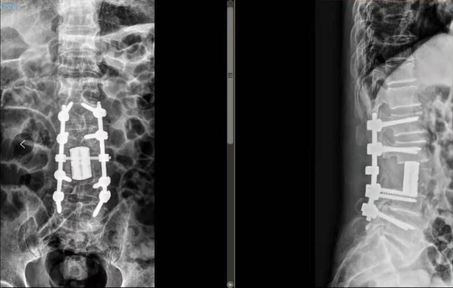 椎体|烟台山医院成功完成全脊柱肿瘤切除＋3D打印人工椎体置换术