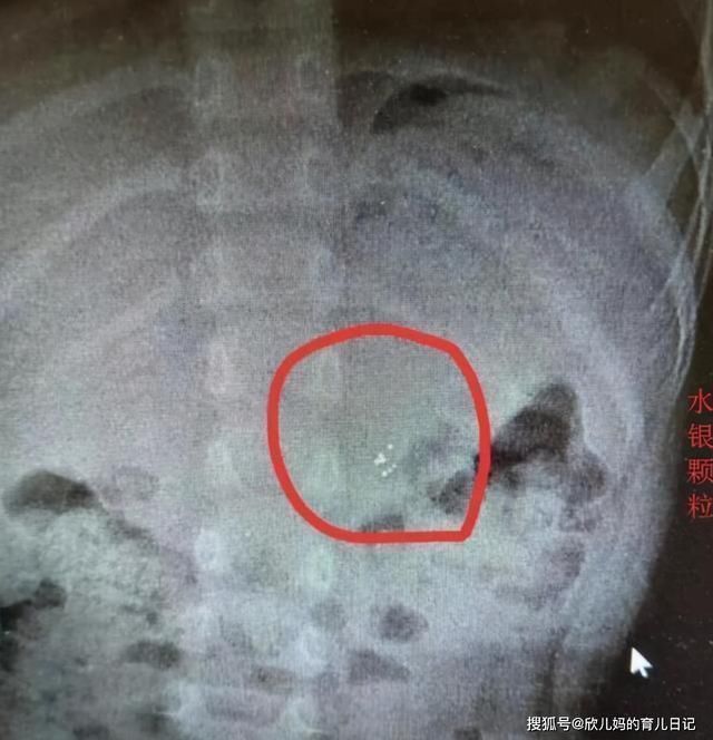 宝妈|3岁男孩误吞水银,奶奶却说吃点韭菜再去医院,医生:做的没毛病