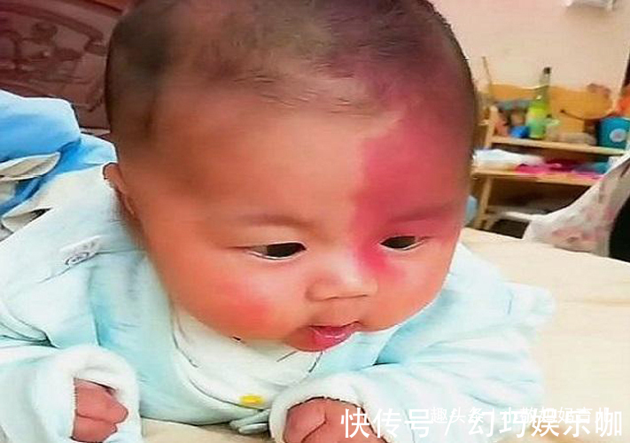 产科医生|胎记是怎么来的?妇科医生:除了遗传,孕期尽量避开这3种行为