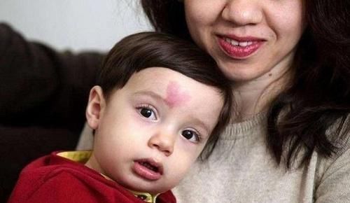 化学物质|胎记是怎么来的?产科大夫:除了遗传,孕期的这3种行为尽量避开