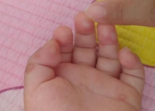 发烧|孩子吹空调吹出手足口病？到底该不该给婴幼儿吹空调？