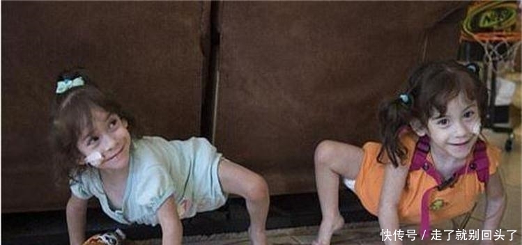 手术|3岁连体姐妹,成功做了人体分离手术,可惜术后每人只有一条腿