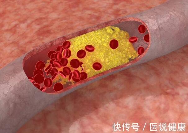 血管|血管的“保护伞”已找到，35岁后不妨多吃5类食物，保持血管健康