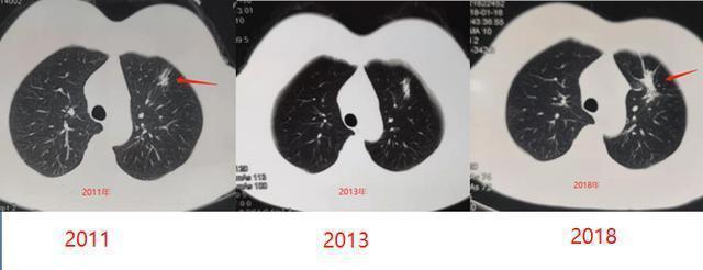 生存期|多数人得了癌症后,为何有人几个月就离世有人却非常长寿