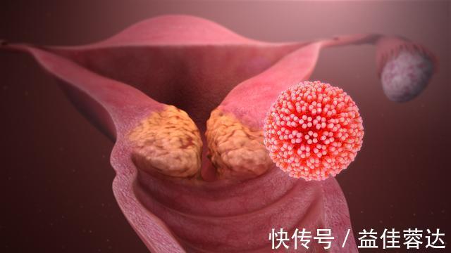 卵巢癌|5种严重的妇科肿瘤,医生希望你知道它们的症状