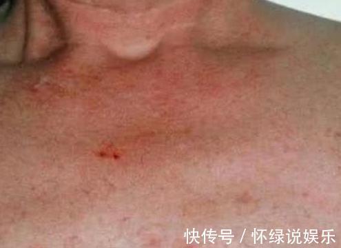 病变|如果你身上出现了2种痣,可能是肝脏病变,不注意就迟了