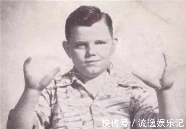 畸形#可恨又可悲的“龙虾手男孩”:畸形跟了他一生,最后死在妻子手里