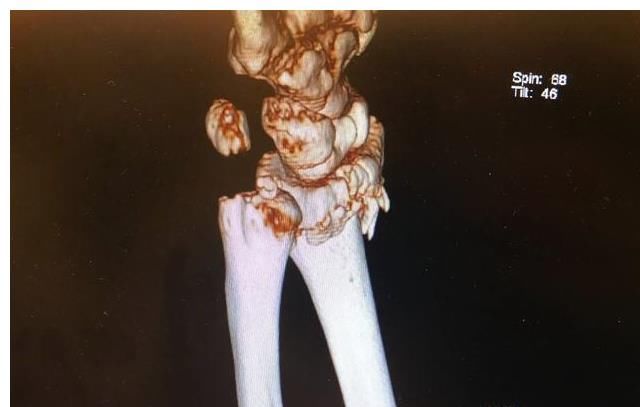 右手桡骨骨折手术照片