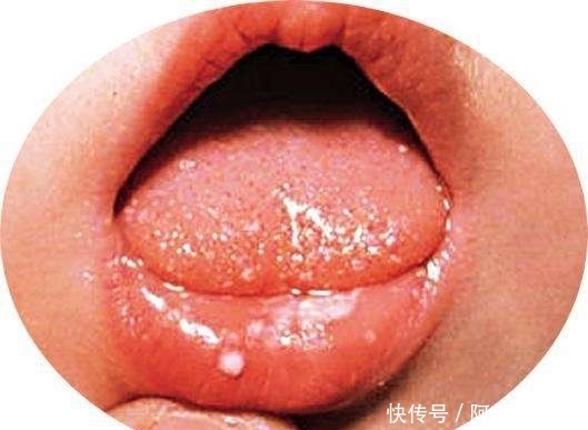 症状|心火过旺的5个表现,多吃4种食物,不失眠、不便秘、睡得香