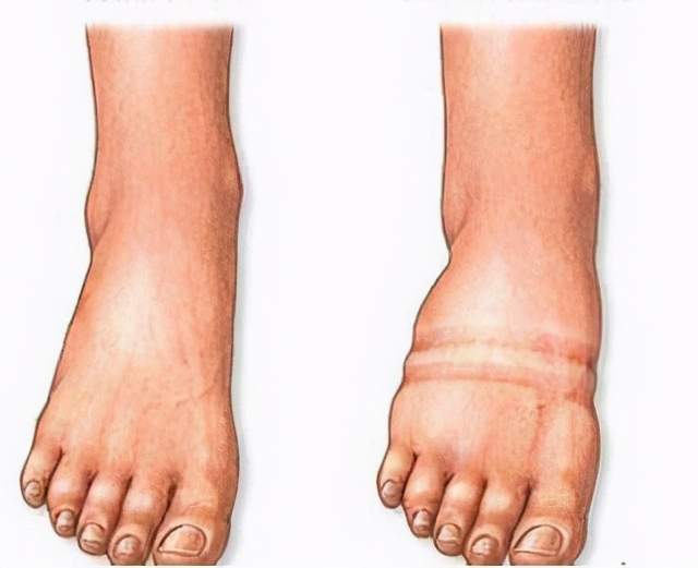 基础代谢|常有6个表现,说明是“易胖体质”,坚持做好4件事,也能瘦下来