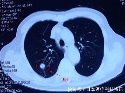 肺癌|为什么要去日本治疗肺癌?