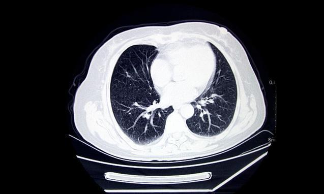 肺癌常见的类型你了解吗？关于2点肺癌的小知识，请你收好