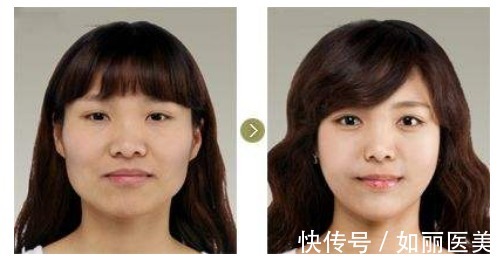 下颌角整形 下颌角磨骨恢复期需要多久?术后有哪些需要注意的,你都知道吗?