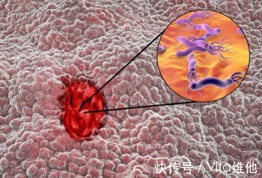 p全球一半胃癌在中国，作为四大危险因素之一，你却忽略了它