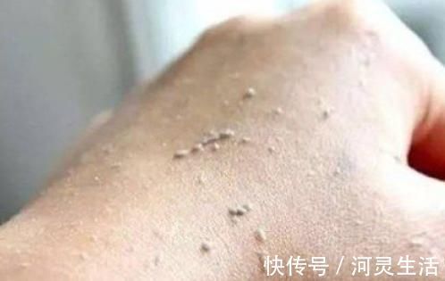 头皮屑|洗澡时若有1种现象，说明体内湿气已超标！这件事别再做了！