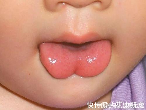 剪舌|滥用的“剪舌系带”，舌系带到底该不该剪？这一刀孩子挨得很无辜