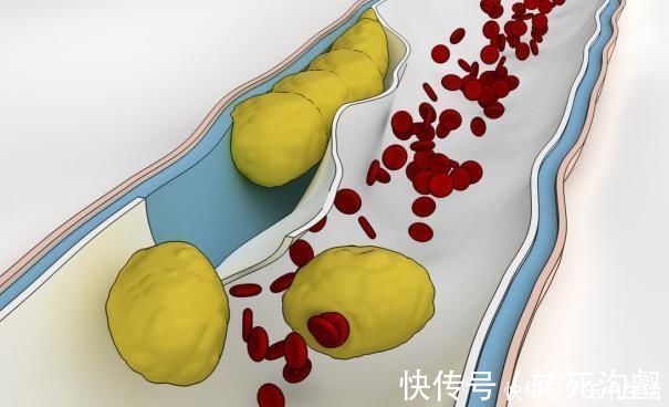 胸闷|“溶栓高手”找到了，不是木耳，没事敞开喝，血栓悄悄地不见了