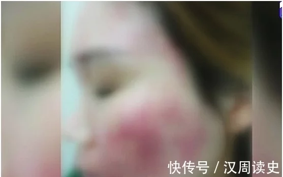 女子用了“微商”面膜,美白变“毁容”,医生:里面有激素插图2 女子用了“微商”面膜,美白变“毁容”,医生:里面有激素插图2