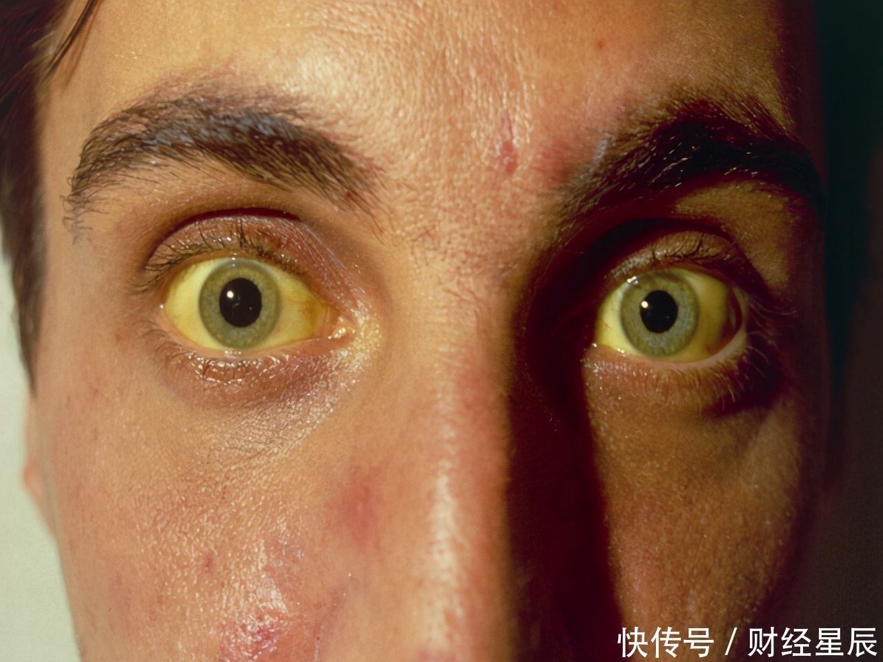 肝癌|10年乙肝史,复查却肝癌晚期,身体早有警报,他却无视了