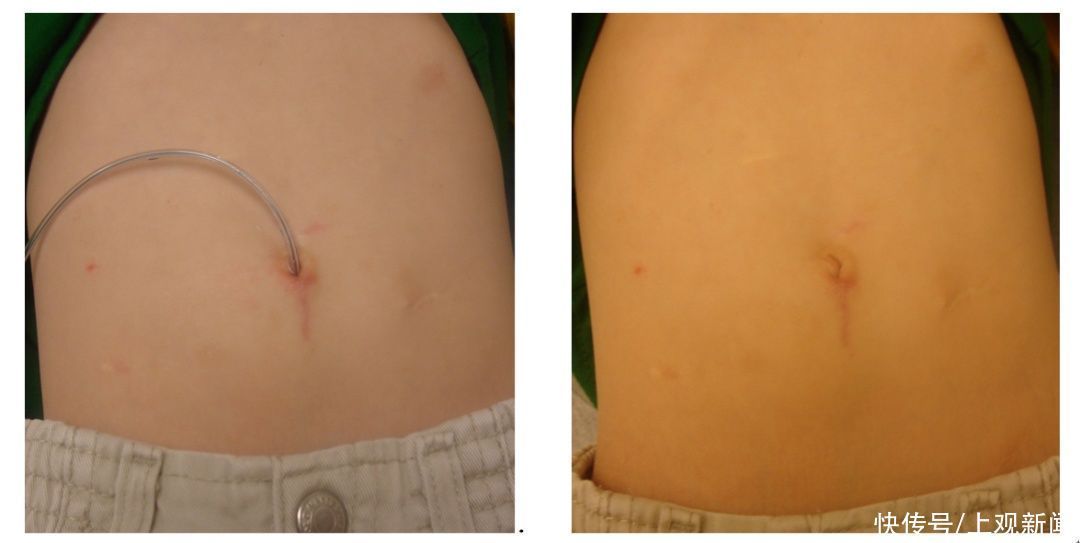 患儿|7岁男孩便便不受控,无法上学!马龙手术来解决,没有阑尾,还可造个