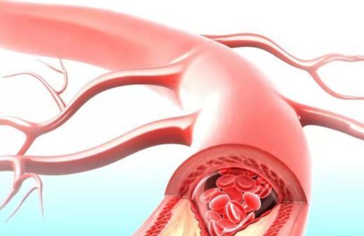 心络胶囊|冬季是冠心病患者的危险期,该注意什么?本文说清