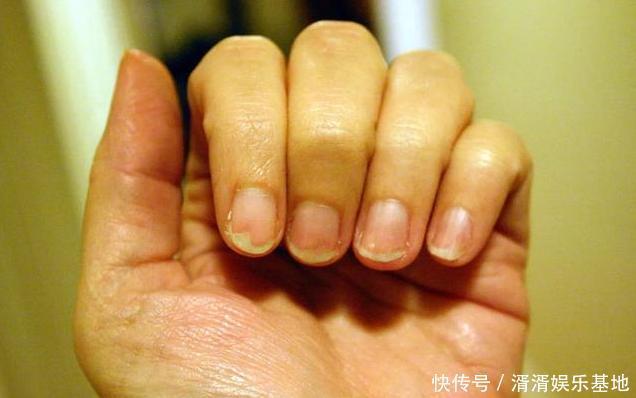 手上出现4个变化，说明肝在求救，多做2事，肝脏不会硬化