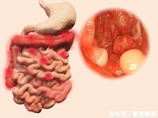 大便突然变细，是肠道内长了异物医生总结5个原因，要引起警惕